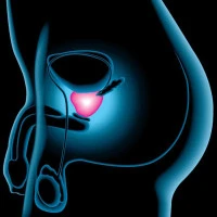 Prostatite
